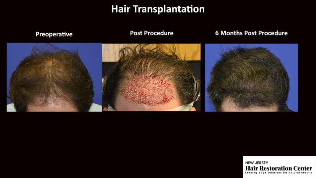 Hair restoration before and after photos