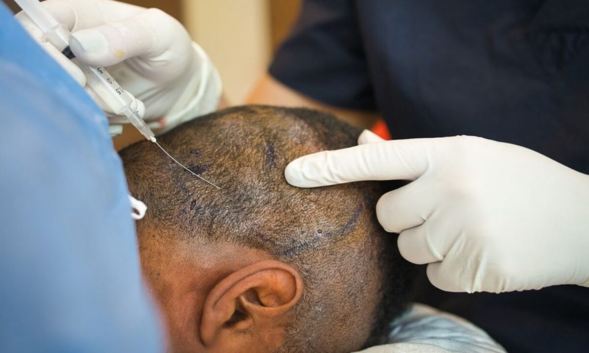scalp fue hair transplant nj
