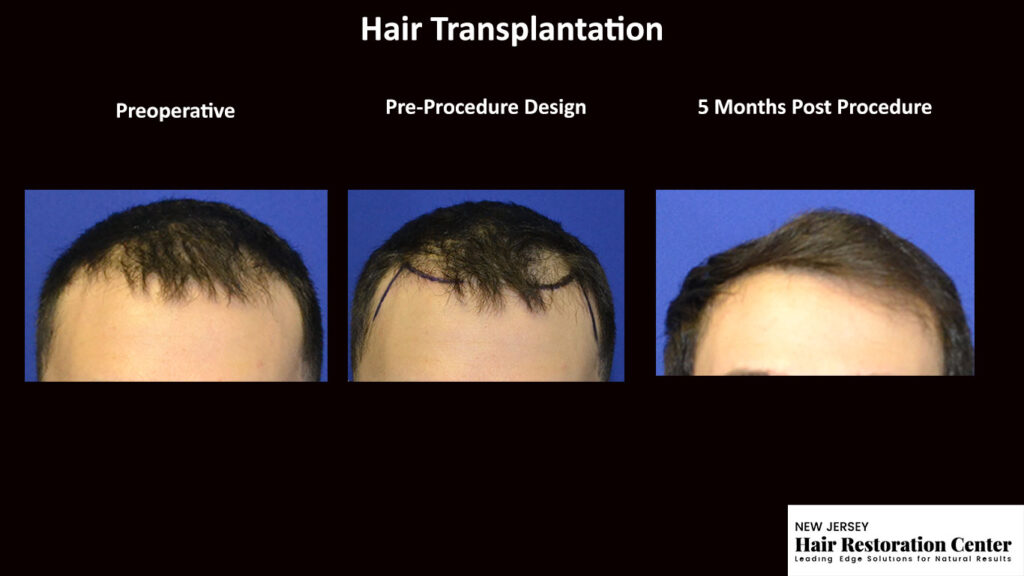 Hair restoration before and after photos