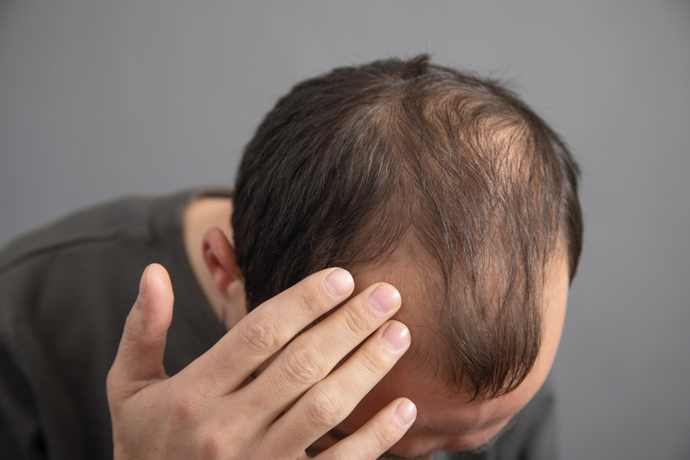 Hair Loss | New Jersey Hair Restoration Center